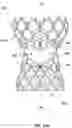 Fig. 49 - Transcatheter heart valve prosthesis systems and methods for rotational alignment
