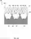 Fig. 50 - Transcatheter heart valve prosthesis systems and methods for rotational alignment
