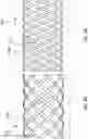 Fig. 16 - DELIVERY SYSTEMS FOR PROSTHETIC HEART VALVES