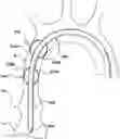 Fig. 01 - Delivery system having an integral centering mechanism for positioning a valve prosthesis in situ