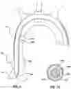 Fig. 02 - Delivery system having an integral centering mechanism for positioning a valve prosthesis in situ