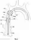 Fig. 03 - Delivery system having an integral centering mechanism for positioning a valve prosthesis in situ