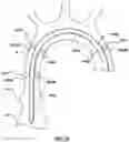 Fig. 08 - Delivery system having an integral centering mechanism for positioning a valve prosthesis in situ