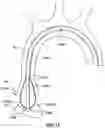 Fig. 13 - Delivery system having an integral centering mechanism for positioning a valve prosthesis in situ