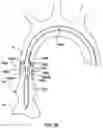 Fig. 14 - Delivery system having an integral centering mechanism for positioning a valve prosthesis in situ