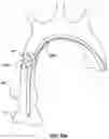 Fig. 17 - Delivery system having an integral centering mechanism for positioning a valve prosthesis in situ