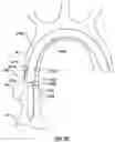 Fig. 20 - Delivery system having an integral centering mechanism for positioning a valve prosthesis in situ