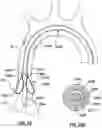 Fig. 22 - Delivery system having an integral centering mechanism for positioning a valve prosthesis in situ