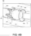 Fig. 06 - INFLATABLE PENILE PROSTHESIS WITH VALVES FOR INCREASING FLOW EFFICIENCY