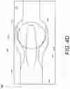 Fig. 08 - INFLATABLE PENILE PROSTHESIS WITH VALVES FOR INCREASING FLOW EFFICIENCY