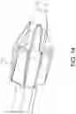 Fig. 18 - INFLATABLE PENILE PROSTHESIS WITH VALVES FOR INCREASING FLOW EFFICIENCY