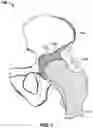 Fig. 02 - Method and system for aligning a prosthesis during surgery