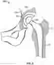 Fig. 03 - Method and system for aligning a prosthesis during surgery