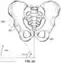 Fig. 04 - Method and system for aligning a prosthesis during surgery