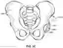 Fig. 06 - Method and system for aligning a prosthesis during surgery