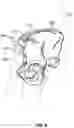 Fig. 11 - Method and system for aligning a prosthesis during surgery