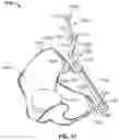 Fig. 13 - Method and system for aligning a prosthesis during surgery