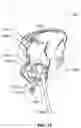 Fig. 15 - Method and system for aligning a prosthesis during surgery