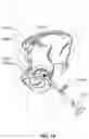 Fig. 17 - Method and system for aligning a prosthesis during surgery