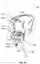 Fig. 18 - Method and system for aligning a prosthesis during surgery