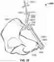 Fig. 21 - Method and system for aligning a prosthesis during surgery