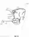 Fig. 22 - Method and system for aligning a prosthesis during surgery