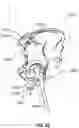 Fig. 23 - Method and system for aligning a prosthesis during surgery