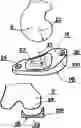 Fig. 01 - TIBIA CONDYLE RESURFACING PROSTHESIS