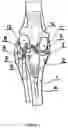Fig. 02 - TIBIA CONDYLE RESURFACING PROSTHESIS