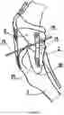 Fig. 03 - TIBIA CONDYLE RESURFACING PROSTHESIS