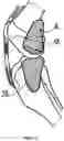 Fig. 04 - TIBIA CONDYLE RESURFACING PROSTHESIS