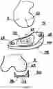 Fig. 05 - TIBIA CONDYLE RESURFACING PROSTHESIS