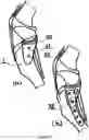 Fig. 07 - TIBIA CONDYLE RESURFACING PROSTHESIS