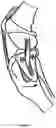 Fig. 08 - TIBIA CONDYLE RESURFACING PROSTHESIS