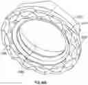 Fig. 21 - Interspinous process implant