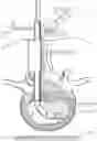 Fig. 07 - Minimally invasive use of robotic appendage for surgery and expansive device and surgical implant