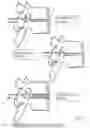 Fig. 17 - Minimally invasive use of robotic appendage for surgery and expansive device and surgical implant
