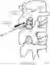 Fig. 19 - Minimally invasive use of robotic appendage for surgery and expansive device and surgical implant