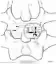 Fig. 20 - Minimally invasive use of robotic appendage for surgery and expansive device and surgical implant