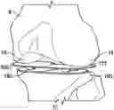 Fig. 01 - BALANCING DEVICE FOR ARTHROPLASTY AND METHODS FOR USE