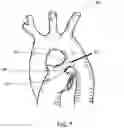 Fig. 07 - PATENT DUCTUS ARTERIOSUS STENT