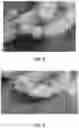 Fig. 08 - PATENT DUCTUS ARTERIOSUS STENT