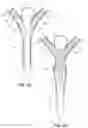 Fig. 06 - Delivery system for a bifurcated stent