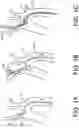 Fig. 02 - Methods of intracerebral implant delivery
