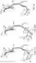 Fig. 47 - Methods of intracerebral implant delivery