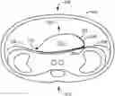 Fig. 01 - Post gastrectomy anchoring procedure