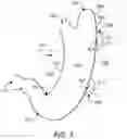 Fig. 03 - Post gastrectomy anchoring procedure