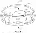Fig. 04 - Post gastrectomy anchoring procedure