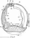 Fig. 05 - Prefabricated Customizable Cranial Remodelling Orthotic