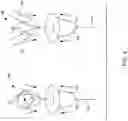 Fig. 05 - Hannah cervical cup